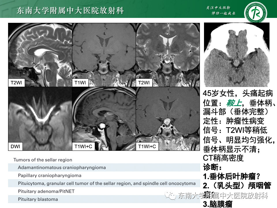 影像PPT - 【PPT】垂体柄病变的影像诊断-21