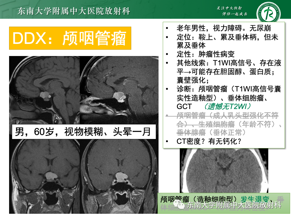 影像PPT - 【PPT】垂体柄病变的影像诊断-24