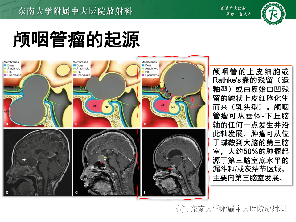 影像PPT - 【PPT】垂体柄病变的影像诊断-25