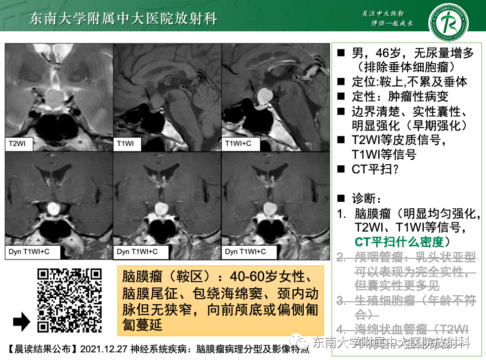 影像PPT - 【PPT】垂体柄病变的影像诊断-27
