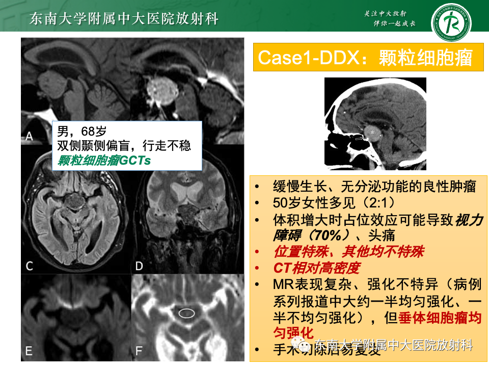 影像PPT - 【PPT】垂体柄病变的影像诊断-23