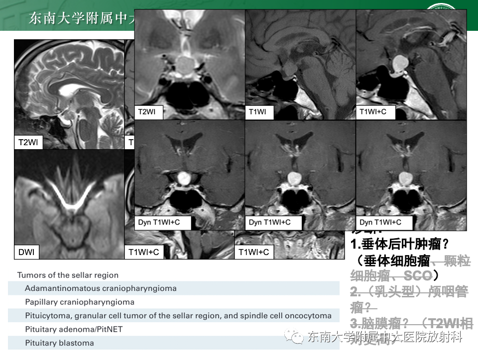 影像PPT - 【PPT】垂体柄病变的影像诊断-28