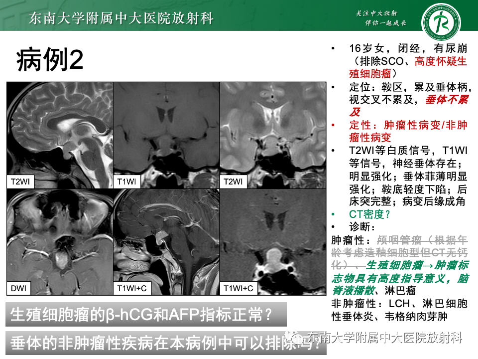 影像PPT - 【PPT】垂体柄病变的影像诊断-30