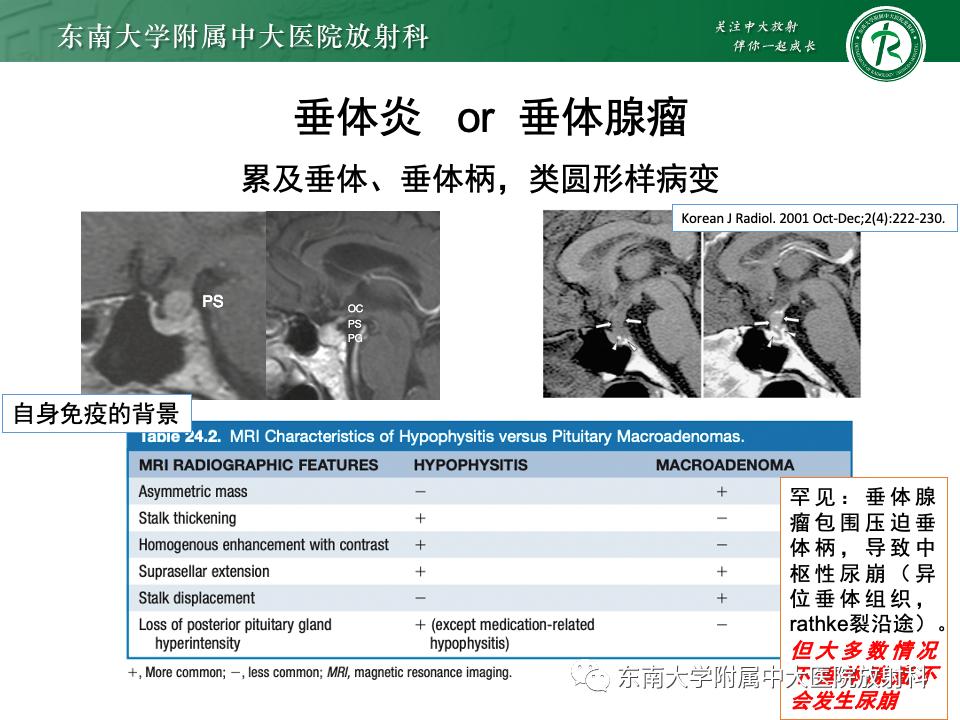 影像PPT - 【PPT】垂体柄病变的影像诊断-35