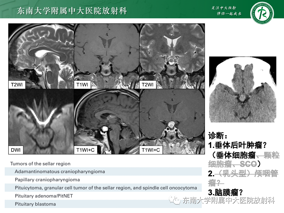 影像PPT - 【PPT】垂体柄病变的影像诊断-26