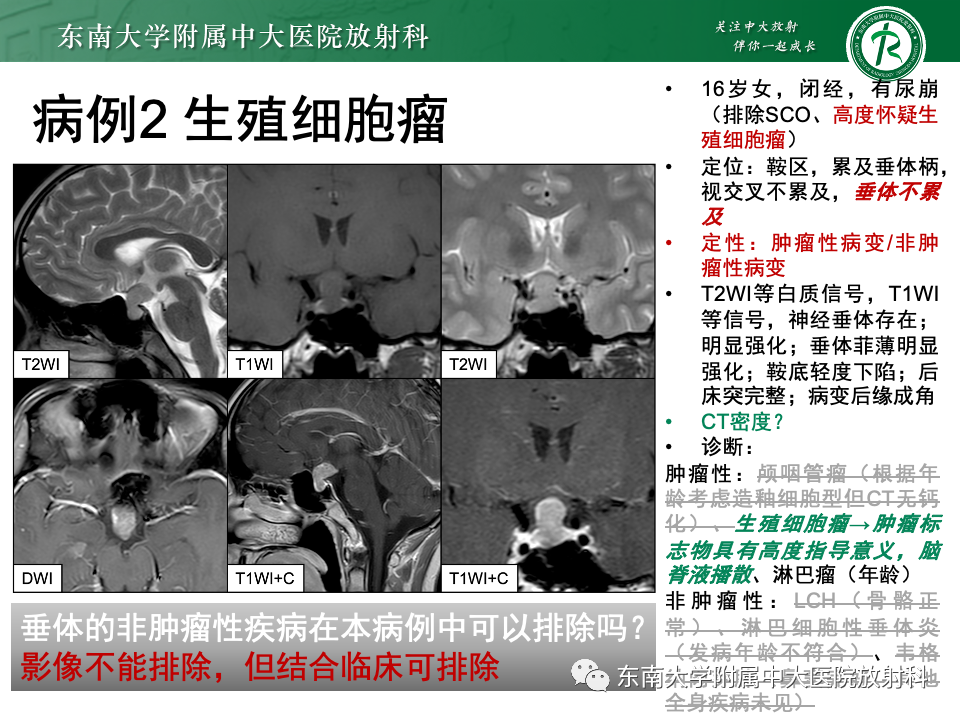 影像PPT - 【PPT】垂体柄病变的影像诊断-36