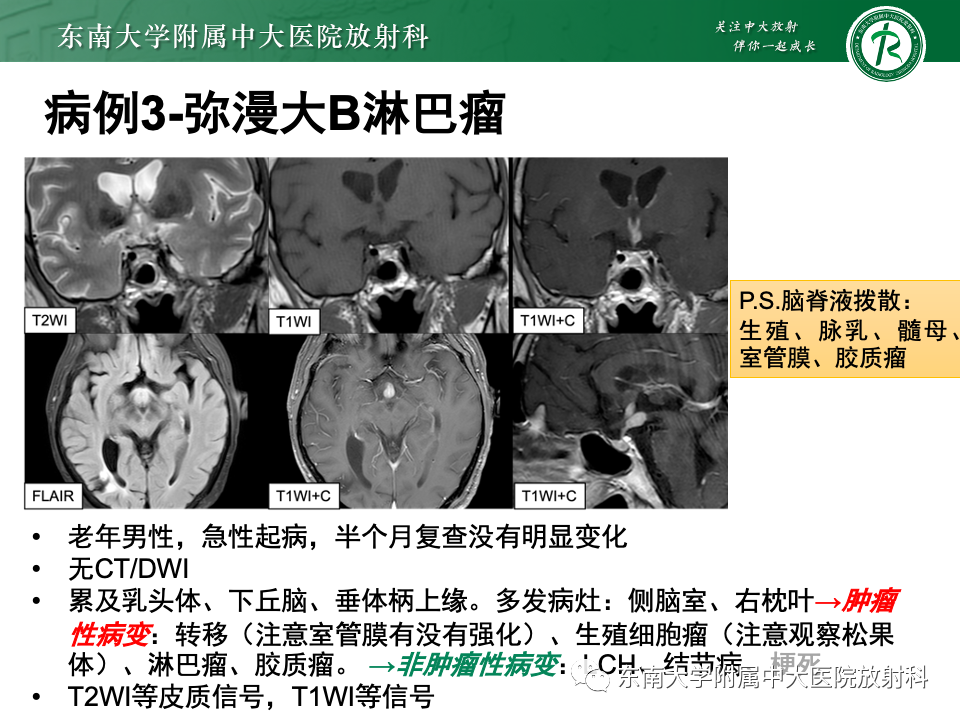 影像PPT - 【PPT】垂体柄病变的影像诊断-37