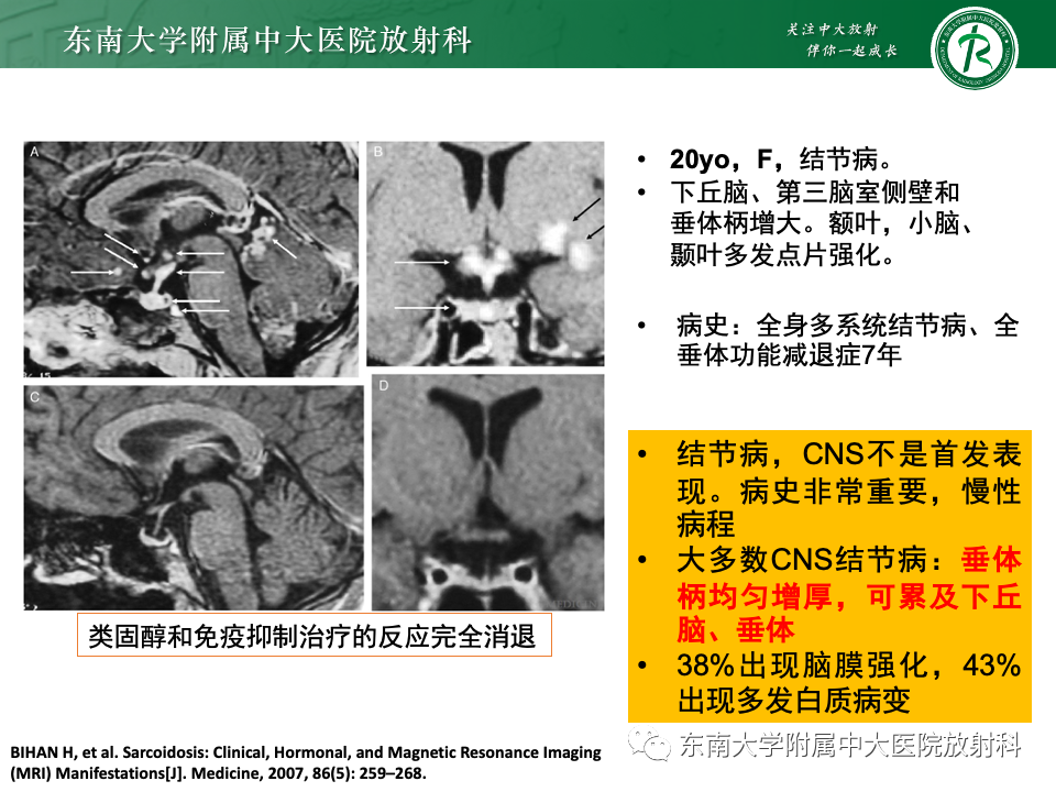 影像PPT - 【PPT】垂体柄病变的影像诊断-38