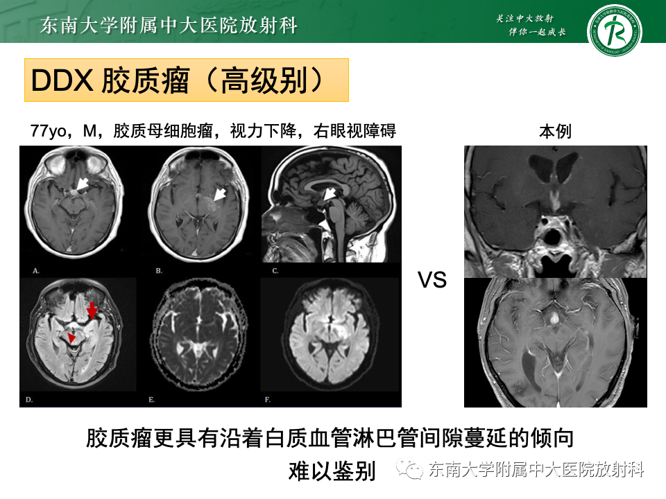 影像PPT - 【PPT】垂体柄病变的影像诊断-39
