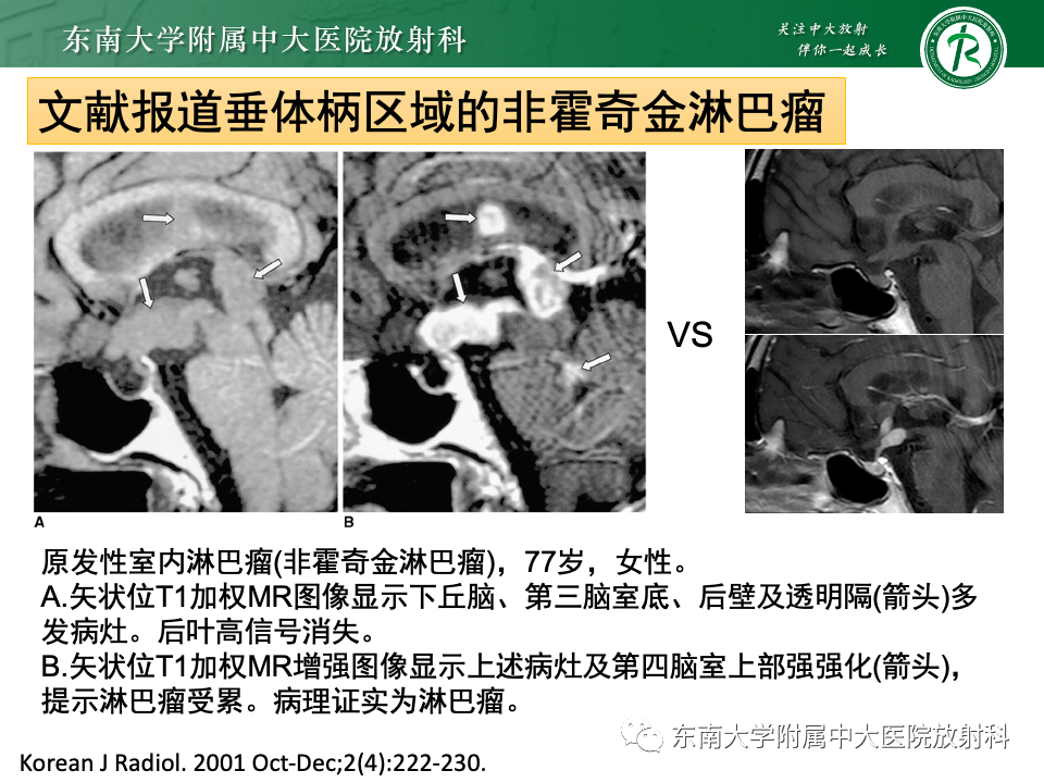 影像PPT - 【PPT】垂体柄病变的影像诊断-40