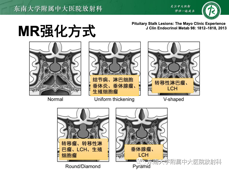 影像PPT - 【PPT】垂体柄病变的影像诊断-44