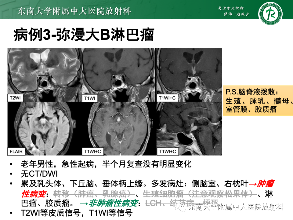 影像PPT - 【PPT】垂体柄病变的影像诊断-2