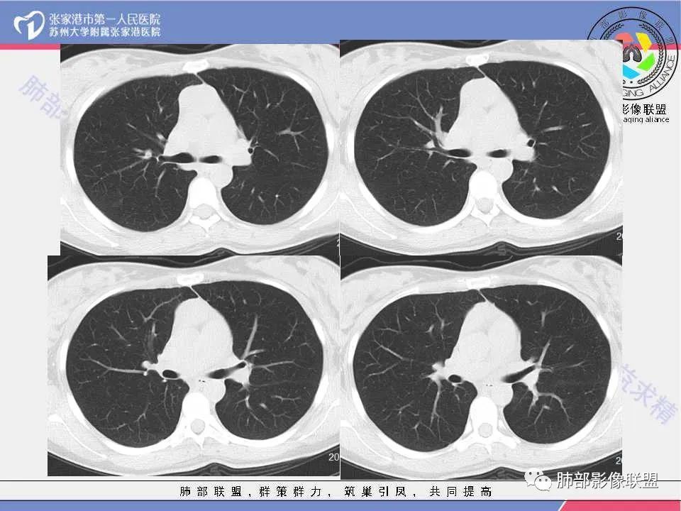 影像PPT - 【病例】年轻女性前纵隔囊变的胸腺瘤1例CT-5 影像PPT - 【病例】年轻女性前纵隔囊变的胸腺瘤1例CT-5