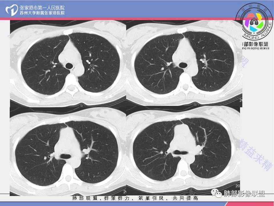 影像PPT - 【病例】年轻女性前纵隔囊变的胸腺瘤1例CT-4 影像PPT - 【病例】年轻女性前纵隔囊变的胸腺瘤1例CT-4