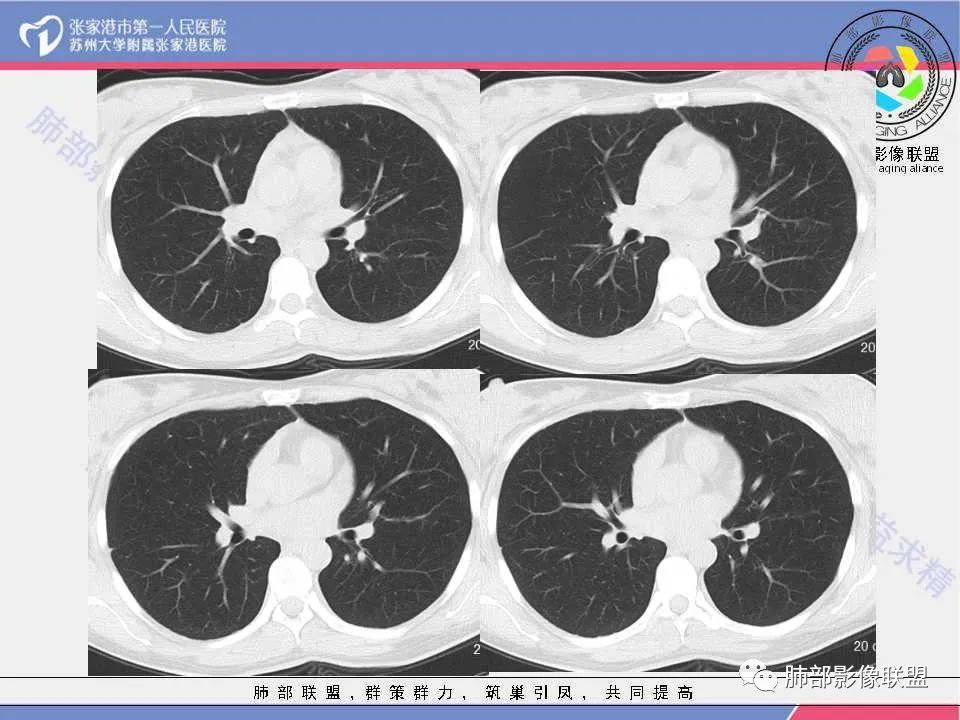 影像PPT - 【病例】年轻女性前纵隔囊变的胸腺瘤1例CT-6 影像PPT - 【病例】年轻女性前纵隔囊变的胸腺瘤1例CT-6