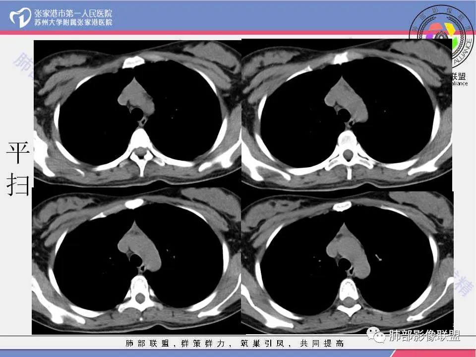 影像PPT - 【病例】年轻女性前纵隔囊变的胸腺瘤1例CT-7 影像PPT - 【病例】年轻女性前纵隔囊变的胸腺瘤1例CT-7