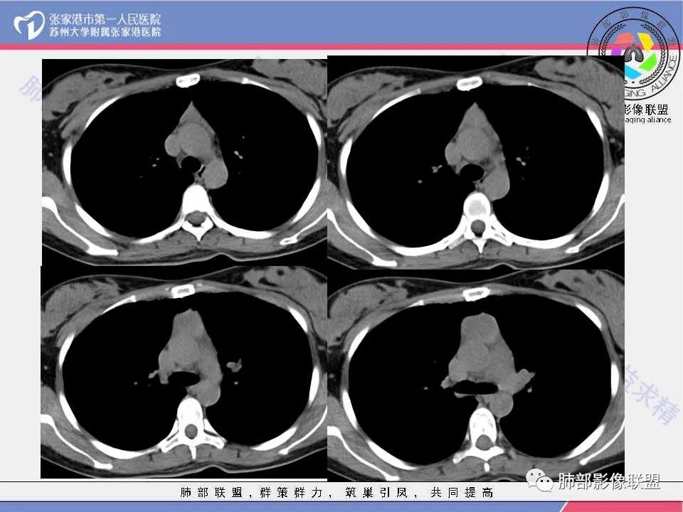 影像PPT - 【病例】年轻女性前纵隔囊变的胸腺瘤1例CT-8 影像PPT - 【病例】年轻女性前纵隔囊变的胸腺瘤1例CT-8