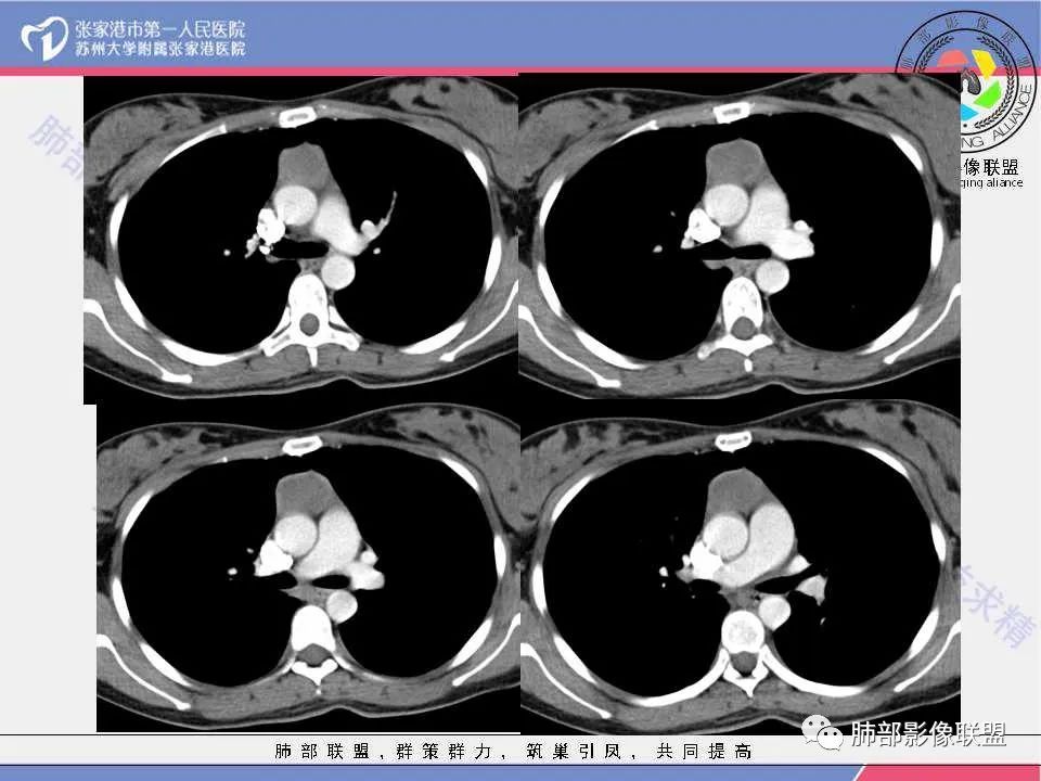 影像PPT - 【病例】年轻女性前纵隔囊变的胸腺瘤1例CT-12 影像PPT - 【病例】年轻女性前纵隔囊变的胸腺瘤1例CT-12