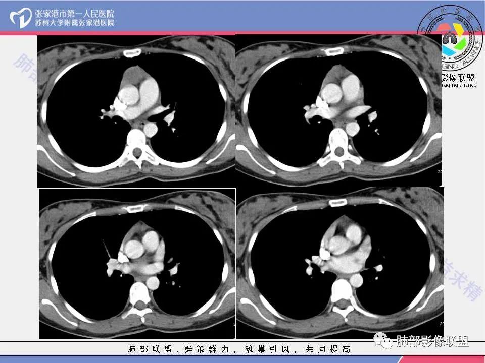 影像PPT - 【病例】年轻女性前纵隔囊变的胸腺瘤1例CT-13 影像PPT - 【病例】年轻女性前纵隔囊变的胸腺瘤1例CT-13