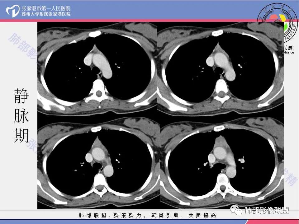 影像PPT - 【病例】年轻女性前纵隔囊变的胸腺瘤1例CT-14 影像PPT - 【病例】年轻女性前纵隔囊变的胸腺瘤1例CT-14