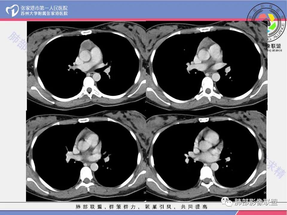 影像PPT - 【病例】年轻女性前纵隔囊变的胸腺瘤1例CT-16 影像PPT - 【病例】年轻女性前纵隔囊变的胸腺瘤1例CT-16
