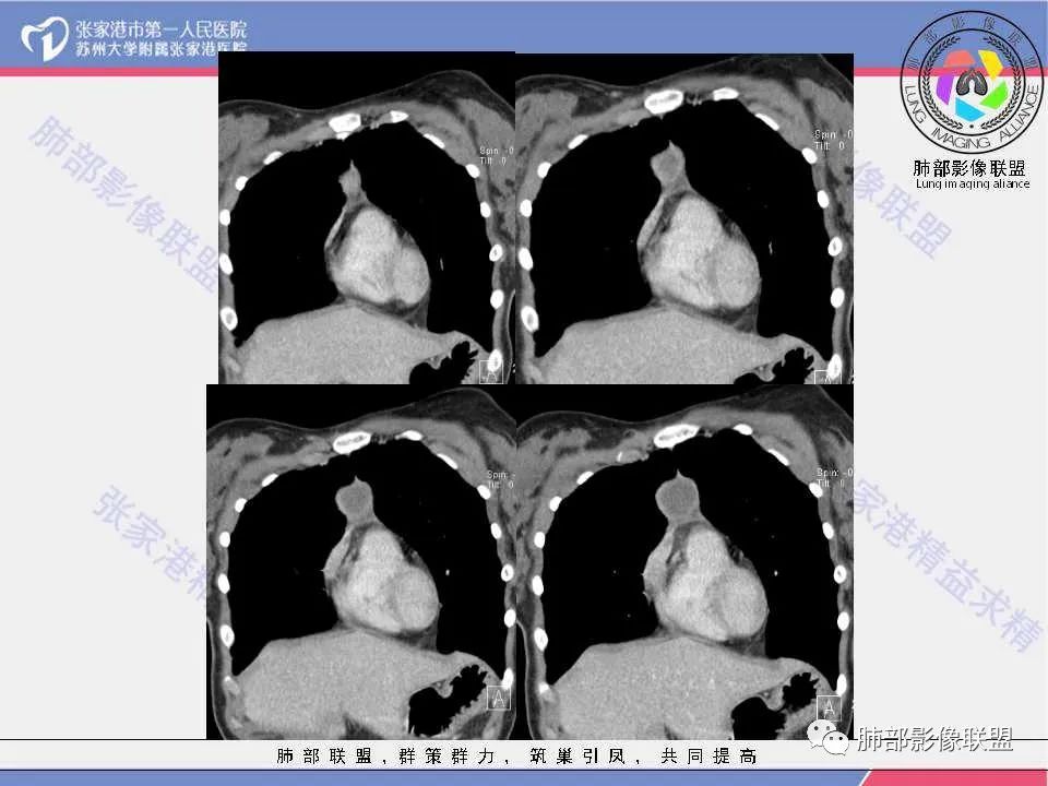 影像PPT - 【病例】年轻女性前纵隔囊变的胸腺瘤1例CT-17 影像PPT - 【病例】年轻女性前纵隔囊变的胸腺瘤1例CT-17