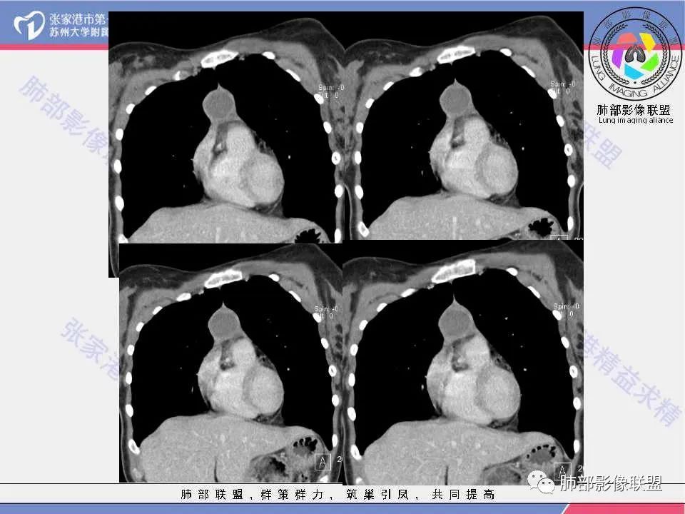 影像PPT - 【病例】年轻女性前纵隔囊变的胸腺瘤1例CT-18 影像PPT - 【病例】年轻女性前纵隔囊变的胸腺瘤1例CT-18