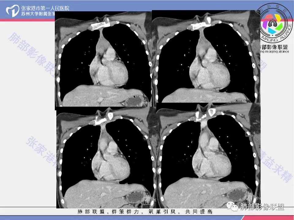 影像PPT - 【病例】年轻女性前纵隔囊变的胸腺瘤1例CT-20 影像PPT - 【病例】年轻女性前纵隔囊变的胸腺瘤1例CT-20