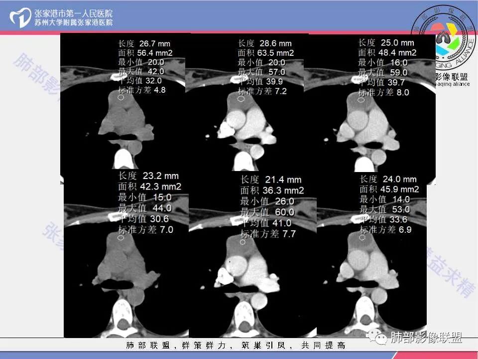 影像PPT - 【病例】年轻女性前纵隔囊变的胸腺瘤1例CT-24 影像PPT - 【病例】年轻女性前纵隔囊变的胸腺瘤1例CT-24