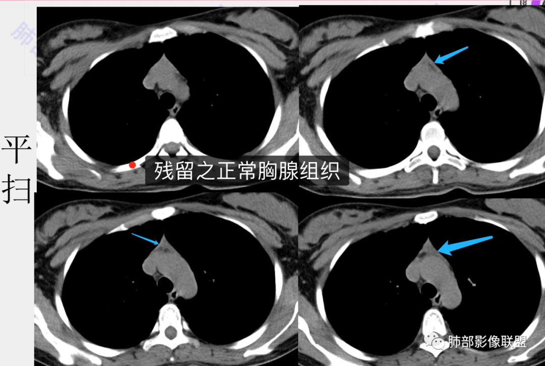 影像PPT - 【病例】年轻女性前纵隔囊变的胸腺瘤1例CT-29 影像PPT - 【病例】年轻女性前纵隔囊变的胸腺瘤1例CT-29