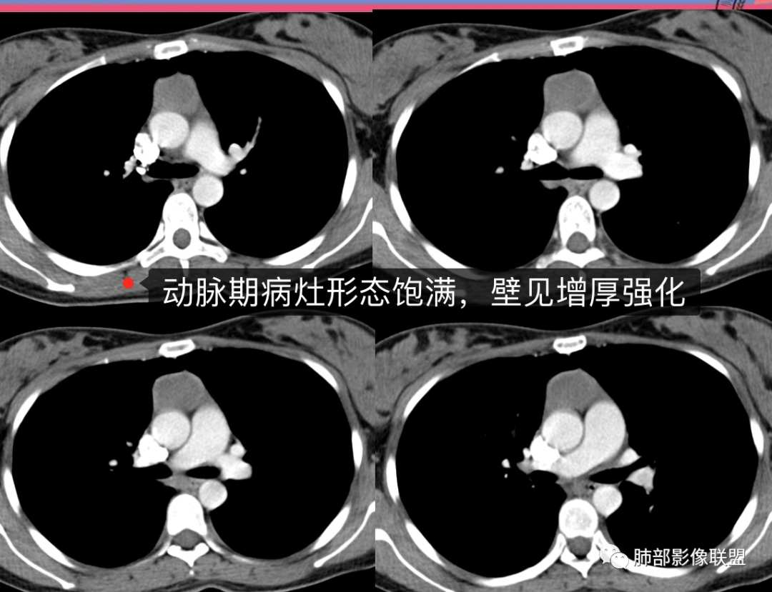 影像PPT - 【病例】年轻女性前纵隔囊变的胸腺瘤1例CT-30 影像PPT - 【病例】年轻女性前纵隔囊变的胸腺瘤1例CT-30
