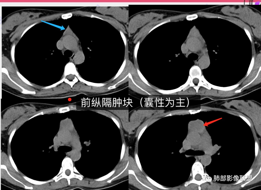 影像PPT - 【病例】年轻女性前纵隔囊变的胸腺瘤1例CT-32 影像PPT - 【病例】年轻女性前纵隔囊变的胸腺瘤1例CT-32