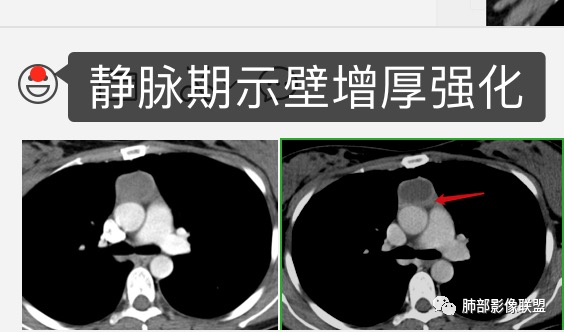 影像PPT - 【病例】年轻女性前纵隔囊变的胸腺瘤1例CT-34 影像PPT - 【病例】年轻女性前纵隔囊变的胸腺瘤1例CT-34