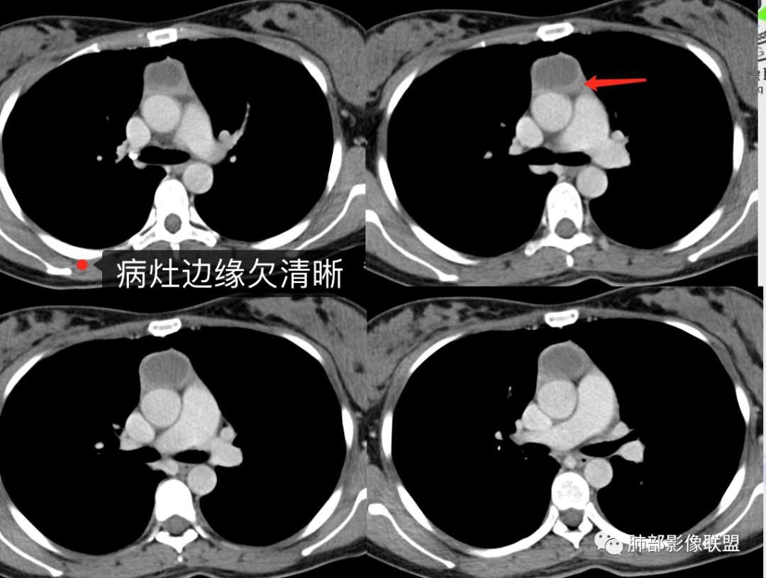 影像PPT - 【病例】年轻女性前纵隔囊变的胸腺瘤1例CT-35 影像PPT - 【病例】年轻女性前纵隔囊变的胸腺瘤1例CT-35