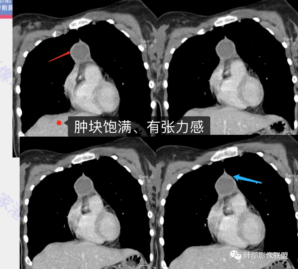 影像PPT - 【病例】年轻女性前纵隔囊变的胸腺瘤1例CT-37 影像PPT - 【病例】年轻女性前纵隔囊变的胸腺瘤1例CT-37