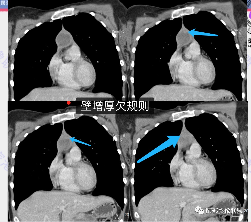 影像PPT - 【病例】年轻女性前纵隔囊变的胸腺瘤1例CT-38 影像PPT - 【病例】年轻女性前纵隔囊变的胸腺瘤1例CT-38