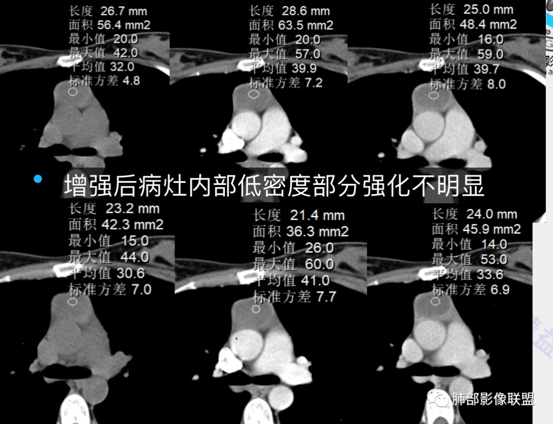 影像PPT - 【病例】年轻女性前纵隔囊变的胸腺瘤1例CT-36 影像PPT - 【病例】年轻女性前纵隔囊变的胸腺瘤1例CT-36
