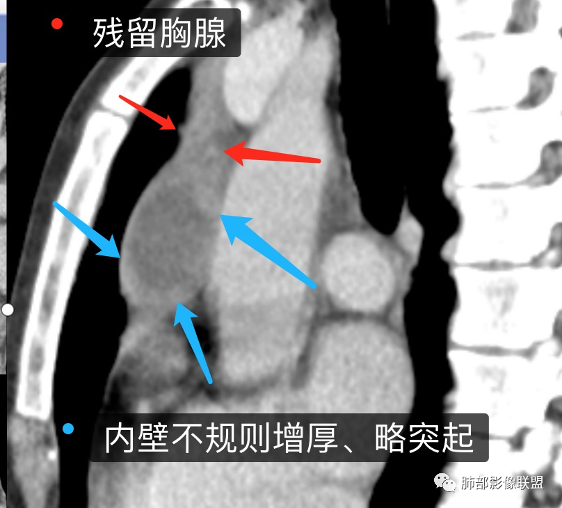 影像PPT - 【病例】年轻女性前纵隔囊变的胸腺瘤1例CT-39 影像PPT - 【病例】年轻女性前纵隔囊变的胸腺瘤1例CT-39