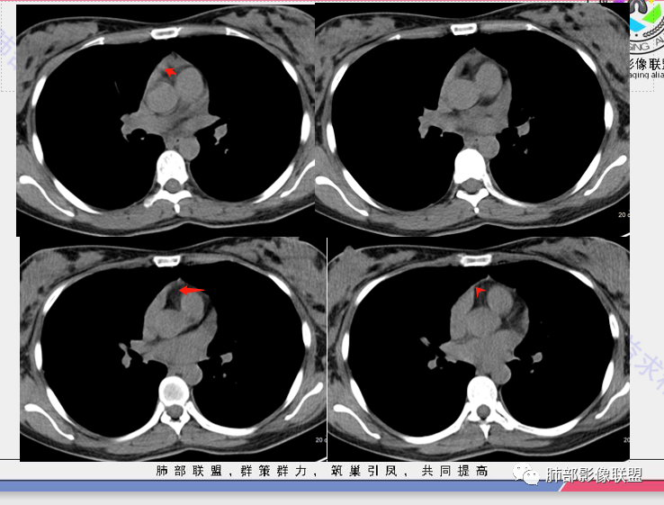 影像PPT - 【病例】年轻女性前纵隔囊变的胸腺瘤1例CT-44