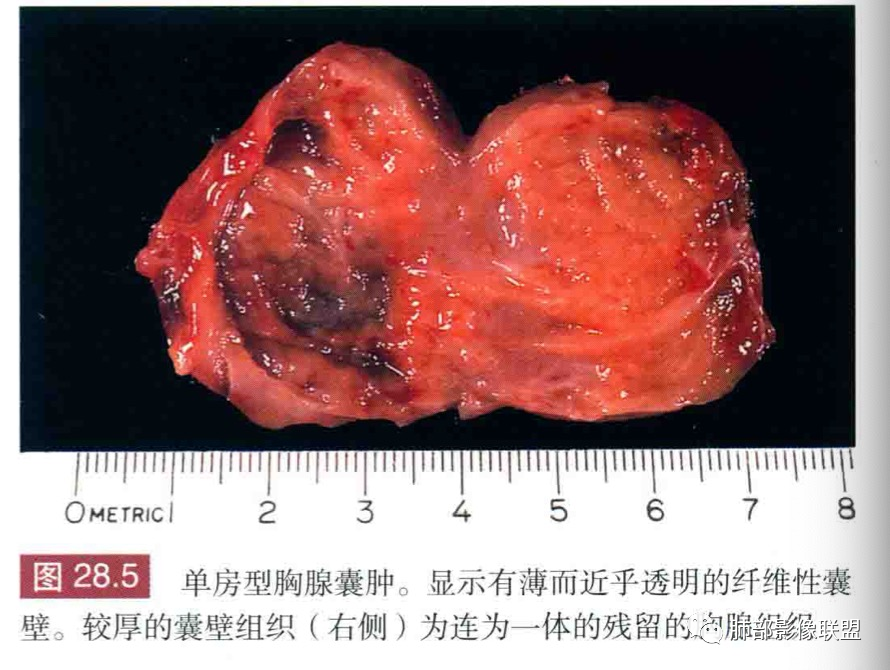 影像PPT - 【病例】年轻女性前纵隔囊变的胸腺瘤1例CT-56