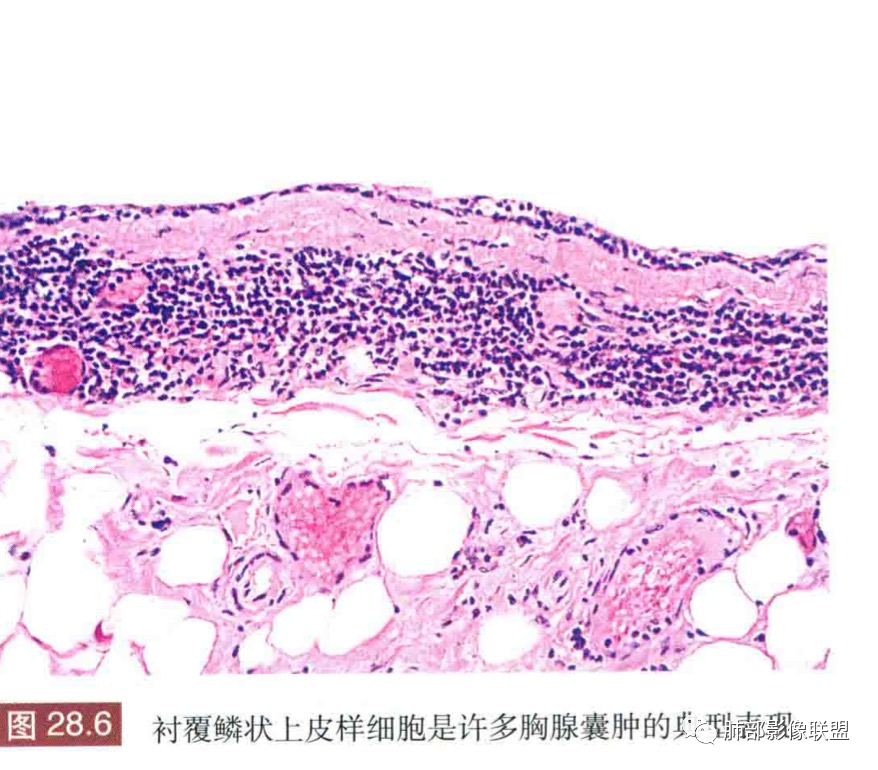 影像PPT - 【病例】年轻女性前纵隔囊变的胸腺瘤1例CT-57