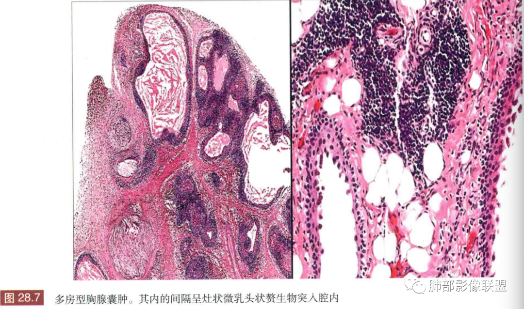 影像PPT - 【病例】年轻女性前纵隔囊变的胸腺瘤1例CT-58