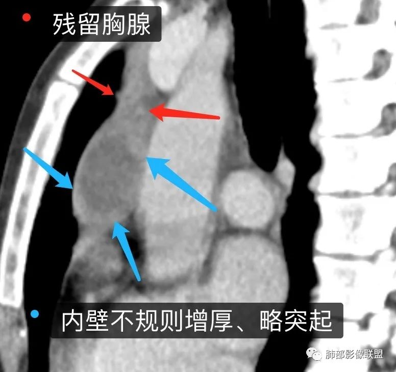 影像PPT - 【病例】年轻女性前纵隔囊变的胸腺瘤1例CT-72 影像PPT - 【病例】年轻女性前纵隔囊变的胸腺瘤1例CT-72