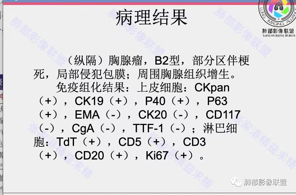 影像PPT - 【病例】年轻女性前纵隔囊变的胸腺瘤1例CT-73 影像PPT - 【病例】年轻女性前纵隔囊变的胸腺瘤1例CT-73
