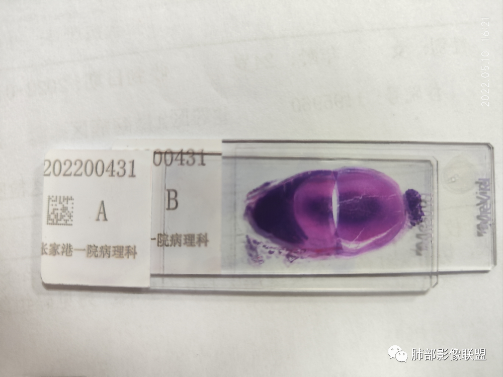 影像PPT - 【病例】年轻女性前纵隔囊变的胸腺瘤1例CT-74 影像PPT - 【病例】年轻女性前纵隔囊变的胸腺瘤1例CT-74