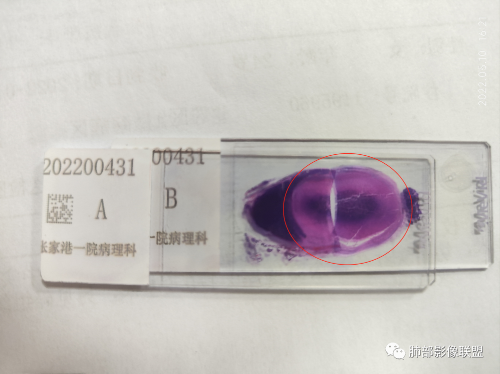 影像PPT - 【病例】年轻女性前纵隔囊变的胸腺瘤1例CT-75