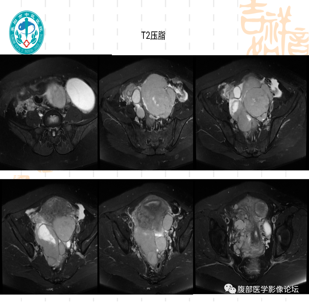 影像PPT - 【病例】子宫内膜间质肉瘤1例MR-6 影像PPT - 【病例】子宫内膜间质肉瘤1例MR-6