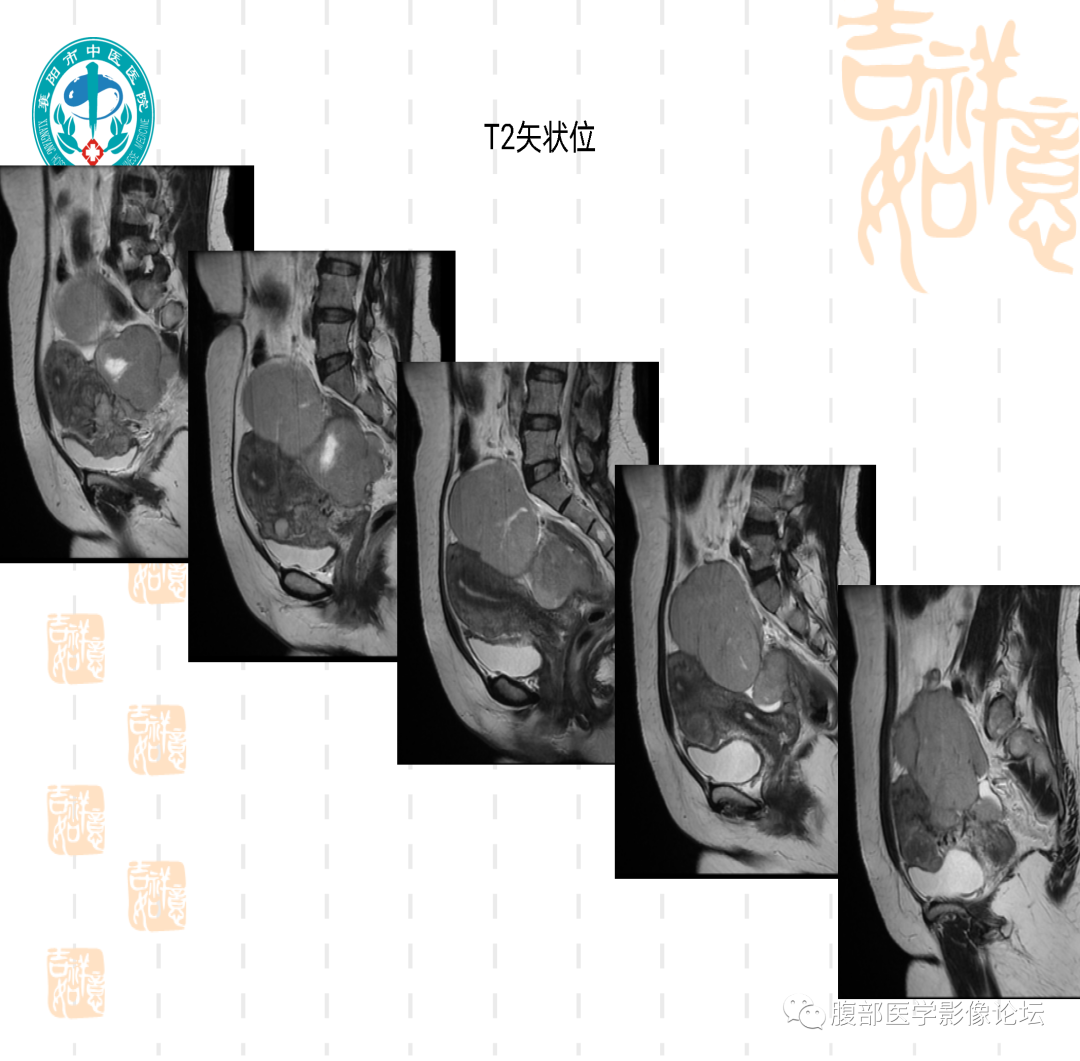 影像PPT - 【病例】子宫内膜间质肉瘤1例MR-7 影像PPT - 【病例】子宫内膜间质肉瘤1例MR-7
