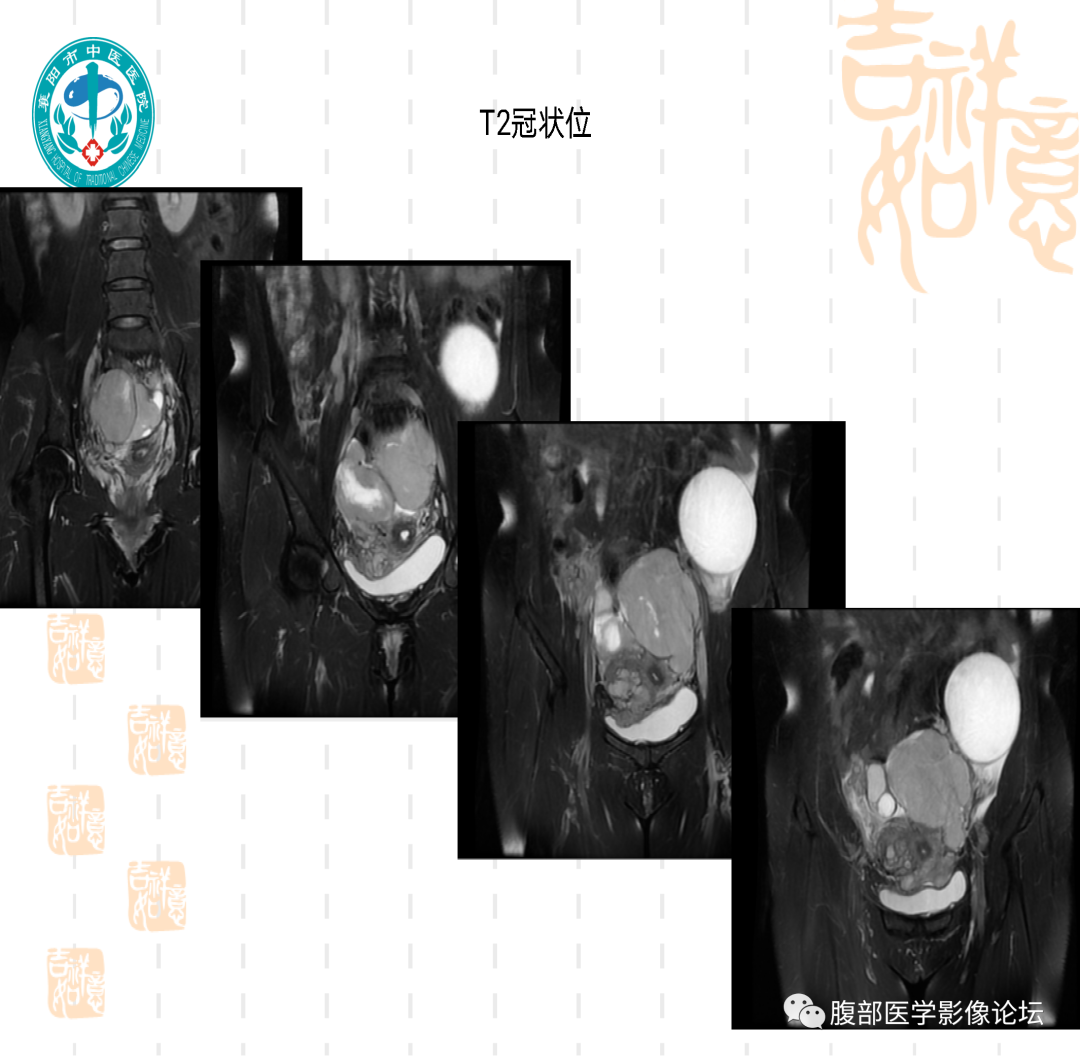 影像PPT - 【病例】子宫内膜间质肉瘤1例MR-8 影像PPT - 【病例】子宫内膜间质肉瘤1例MR-8