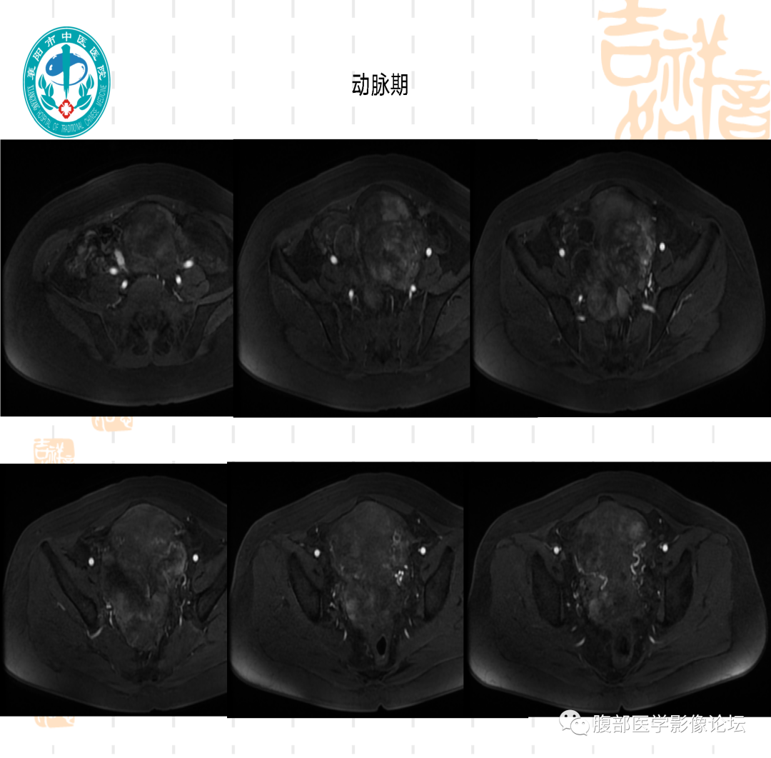 影像PPT - 【病例】子宫内膜间质肉瘤1例MR-10 影像PPT - 【病例】子宫内膜间质肉瘤1例MR-10